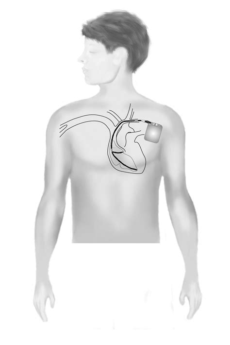 What Is The Icd 10 Code For Breast Tenderness