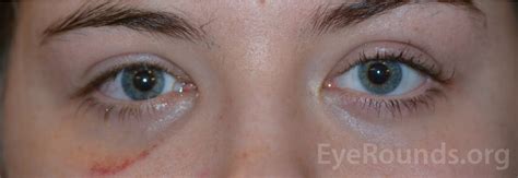 maxillary sinus mucocele