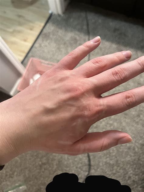 Lamotrigine Rash? : r/Epilepsy