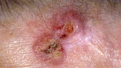 Basal Cell Carcinoma Early Stages Face