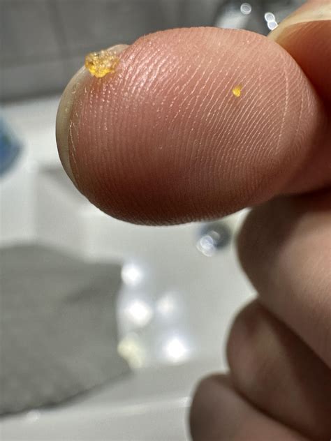 Yellow hard unknown things coming from scalp also included itchiness