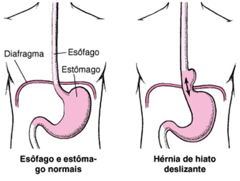 Pequena Hérnia Gástrica Hiatal - Hernia Center Hérnia Hiatal e Refluxo Gastroesofágico
