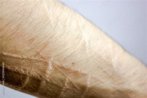scars  cuts   arm suicidecut marks  arms stock photo