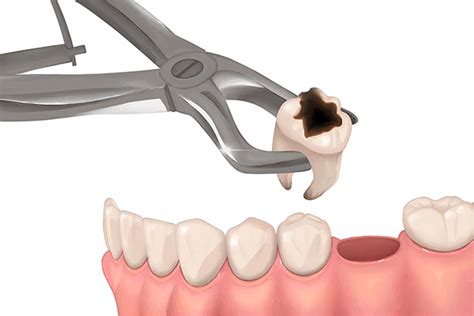 painless tooth extraction  ho chi minh safe painless removal