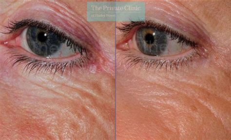 laser skin resurfacing tpc  private clinic  harley street