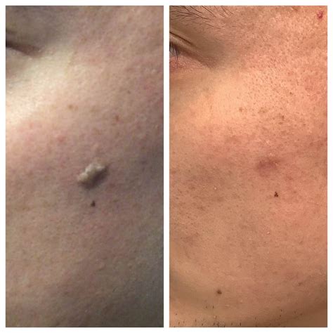 Seborrheic Keratosis Face Removal Seborrheic Keratosis Pennsylvania