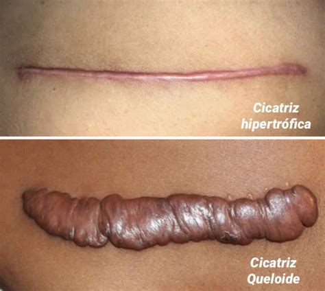 Remoção de Sinais e Correção de Cicatrizes