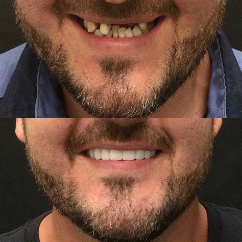Memphis Dentures and Implants