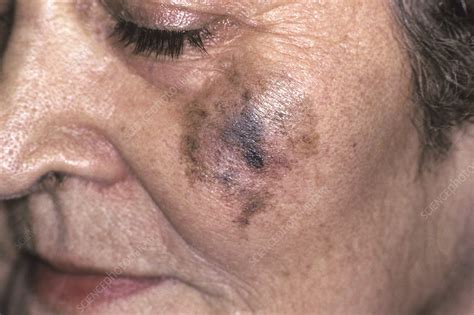 Lentigo maligna melanoma - Stock Image - C053/1985 - Science Photo Library