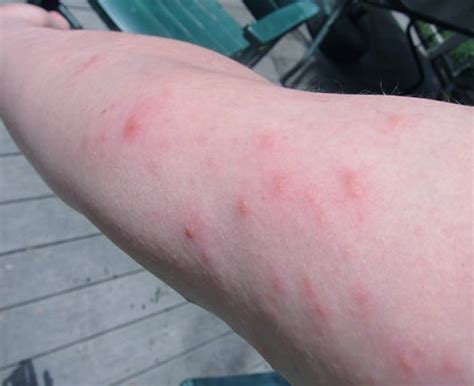 Poison Ivy Rash - Pictures, Treatment, Symptoms, Contagious, Duration