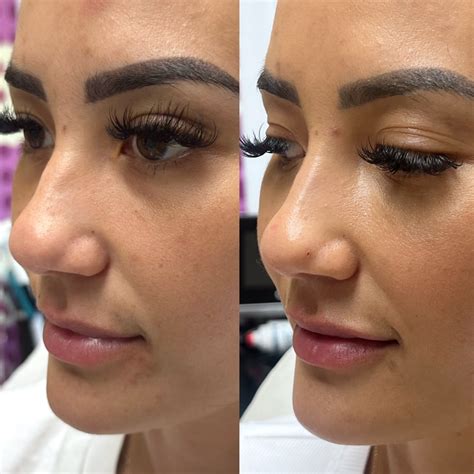 The nose thread lift as the new nonsurgical Rhinoplasty - Hush LA Medspa