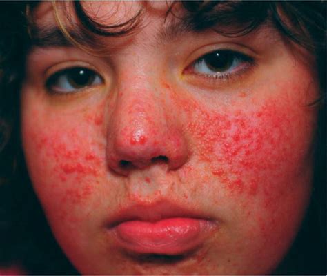 erythematous papules   face aafp