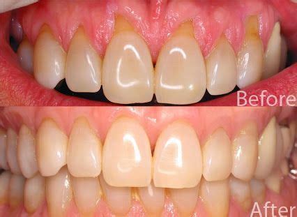 Receding Gums Treatment | Pearl Dental Clinic | Kingston, London