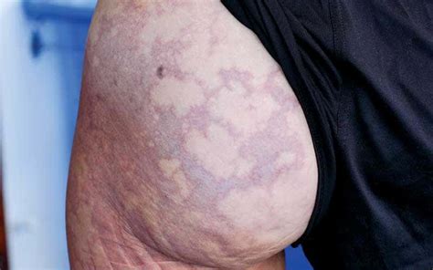 skin bends  guide  cutaneous decompression sickness