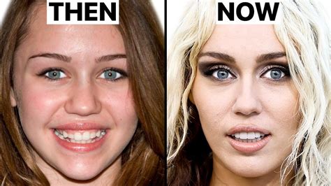 happened  miley cyrus face plastic surgery analysis miley