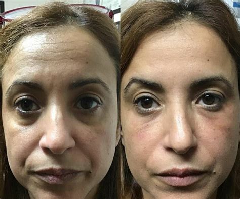 Radiesse Deixa O Rosto Gordo - Radiesse para repor Volume Facial - Preenche e Estimula o Colágeno
