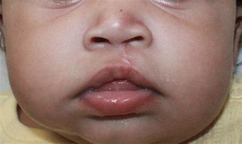 Repair of Incomplete Cleft Lip - Kansas Cleft and Craniofacial Center