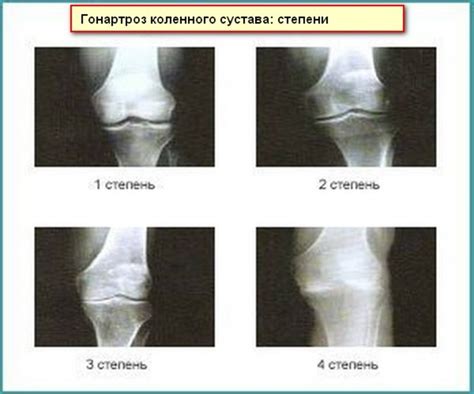 Гонартроз коленного сустава 2 степени: причины и признаки заболевания ...