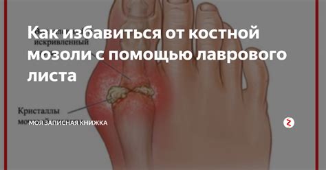 Лечение костной мозоли с помощью лаврового листа | Медицина, Мужчины, Лето