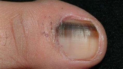 Nail melanoma: know the signs | The Senior | Senior