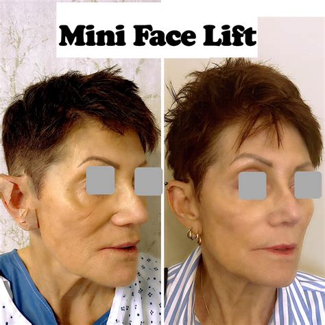facelift surgery  psychological impact  boosting confidence