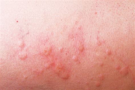 Skin Rashes In Children