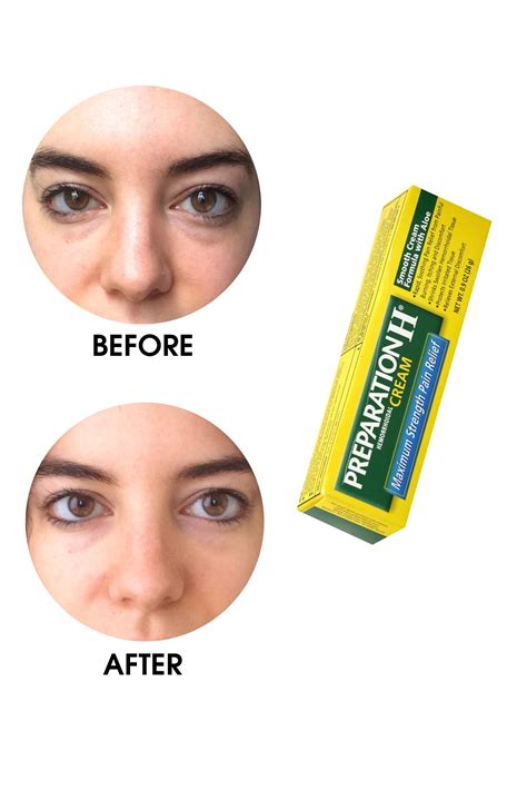 eye bags 3