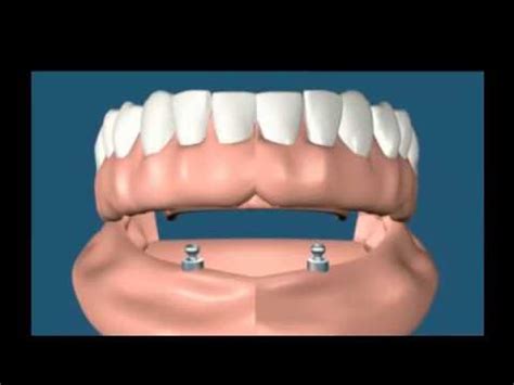 lower overdenture.mp4 - YouTube