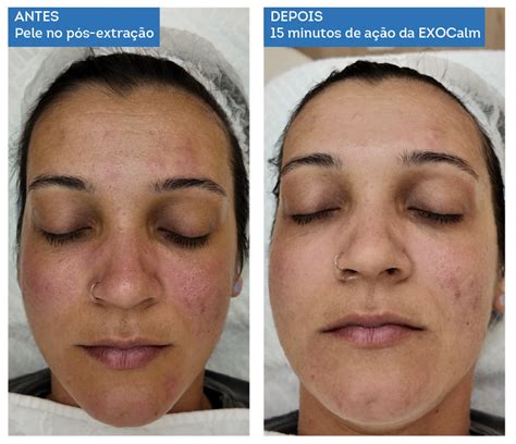 Exossomos Antes E Depois