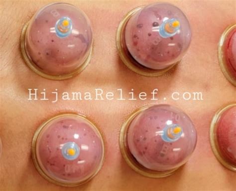 Photos of Hijama – Hijama Relief