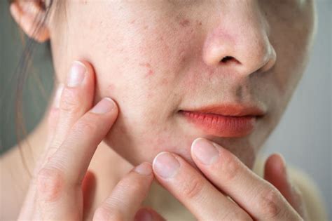 "J’ai tenté d’éclater un bouton sur mon visage, c’était en réalité un ...