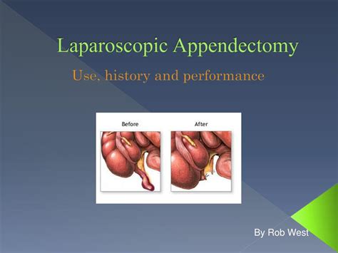 PPT - Laparoscopic Appendectomy PowerPoint Presentation - ID:448972