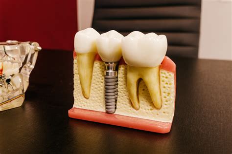 Dental implants with screw on table in clinic · Free Stock Photo