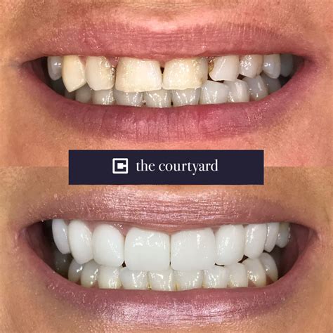 Porcelain Veneers in Huddersfield | The Courtyard