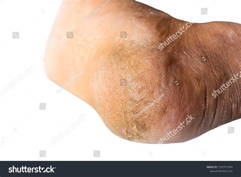 Cracked Skin On Heels Dry Skin Stock Photo 1295751994 | Shutterstock