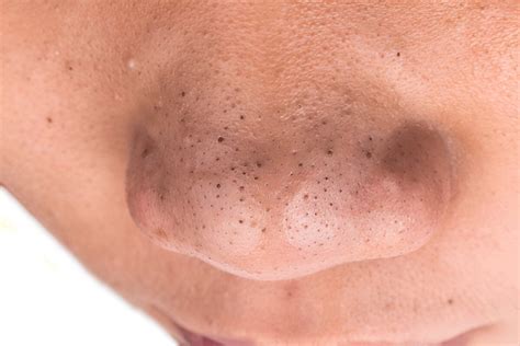 The Ugly Truth About Big Blackheads Why They Pop And How To Prevent Them