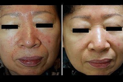 Rosacea treatment for acne-like breakouts - Dermatologist in Pensacola ...