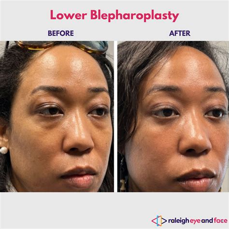 Lower Eyelid Blepharoplasty Raleigh | Bilateral Eyelid Surgery Research