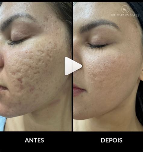 phenol peel is amazing : r/AcneScars