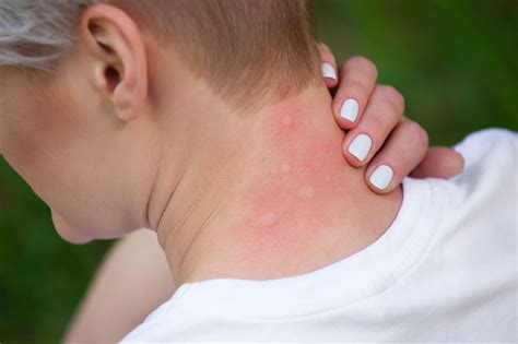Russia warns of increase in cases of West Nile Virus: All about it ...