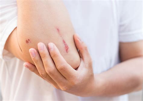 Wound Care Experiences in Western Australian Community Pharmacies