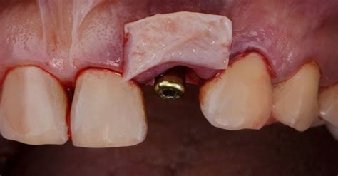 how long does a gum graft take to heal