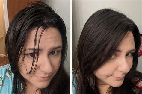 how to get rid of dark spots from bumps 13