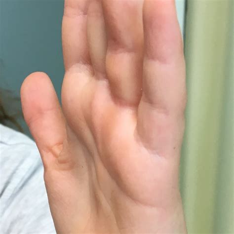 Clinical image of her affected hand/palm showing volar swelling of her ...