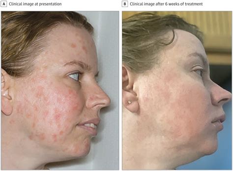 jama dermatology  linkedin improvement  facial discoid dermatosis