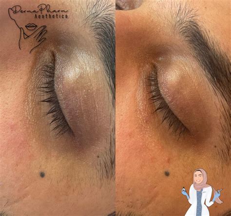 PRP Under Eye Treatment - DermaPharm Aesthetics