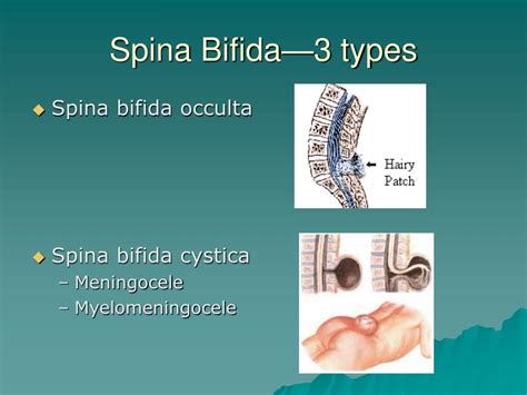 PPT - Spina Bifida PowerPoint Presentation, free download - ID:304143