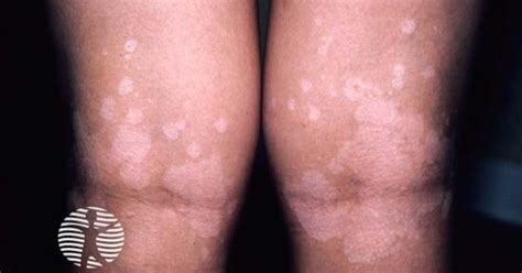pityriasis versicolour image