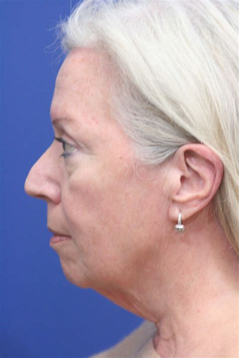 Neck Surgery (Liposuction) - Synergi Facial Surgery