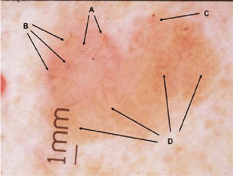 basal cell carcinoma  arborizing vessels   pigmented